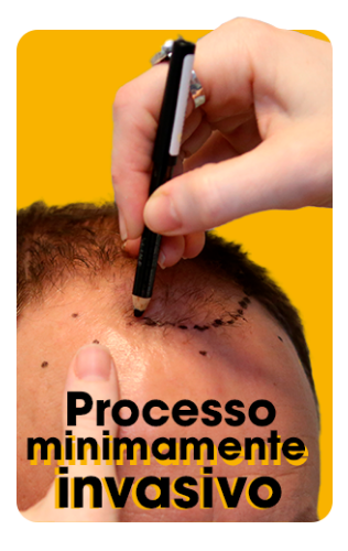 Processo minimamente invasivo Imagem de um médico desenhando com uma caneta no couro cabeludo de um homem calvo