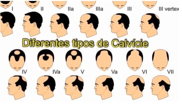 Thumbnail do vídeo sobre diferentes tipos de calvície