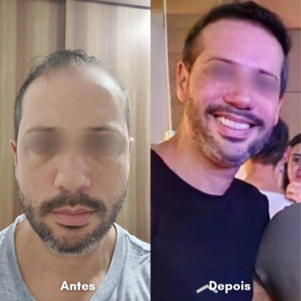 Antes e depois de transplante capilar