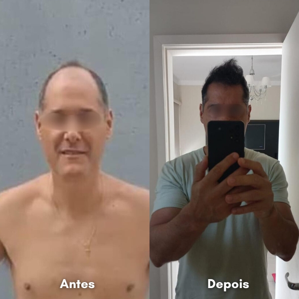 Antes e depois de transplante capilar