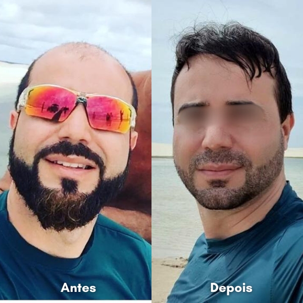 Antes e depois de transplante capilar