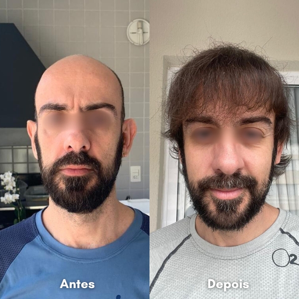 Antes e depois de transplante capilar