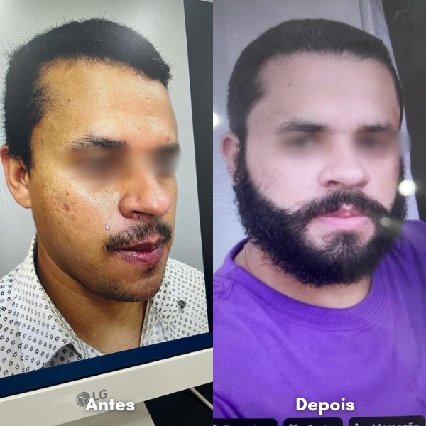 Antes e depois de transplante capilar