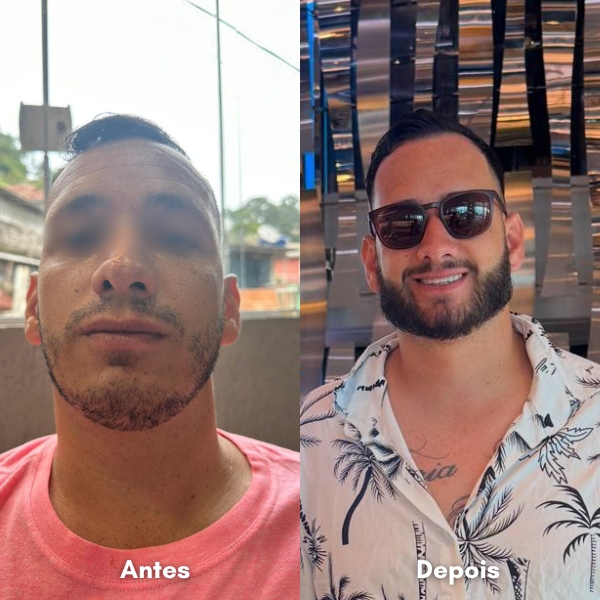 Antes e depois de transplante capilar