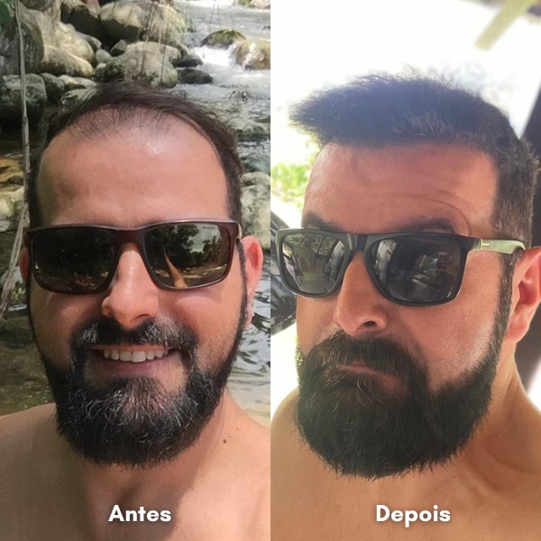 Antes e depois de transplante capilar
