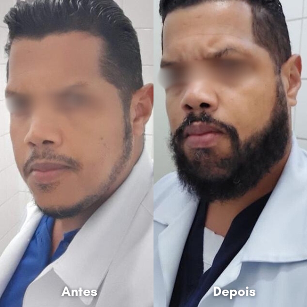 Antes e depois de transplante capilar