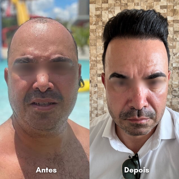 Antes e depois de transplante capilar
