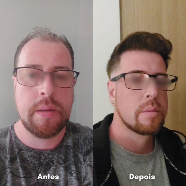 Antes e depois de transplante capilar