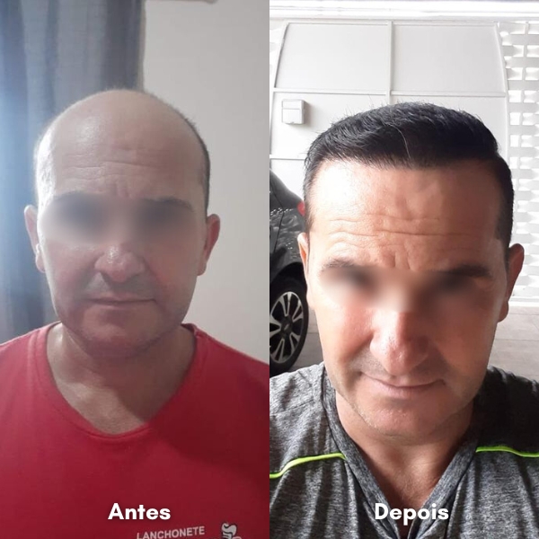 Antes e depois de transplante capilar