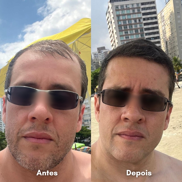 Antes e depois de transplante capilar